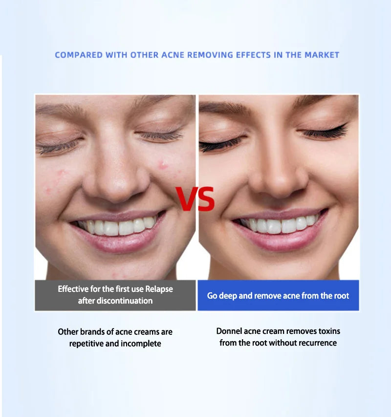 Anti-Acne Cream with Salicylic Acid